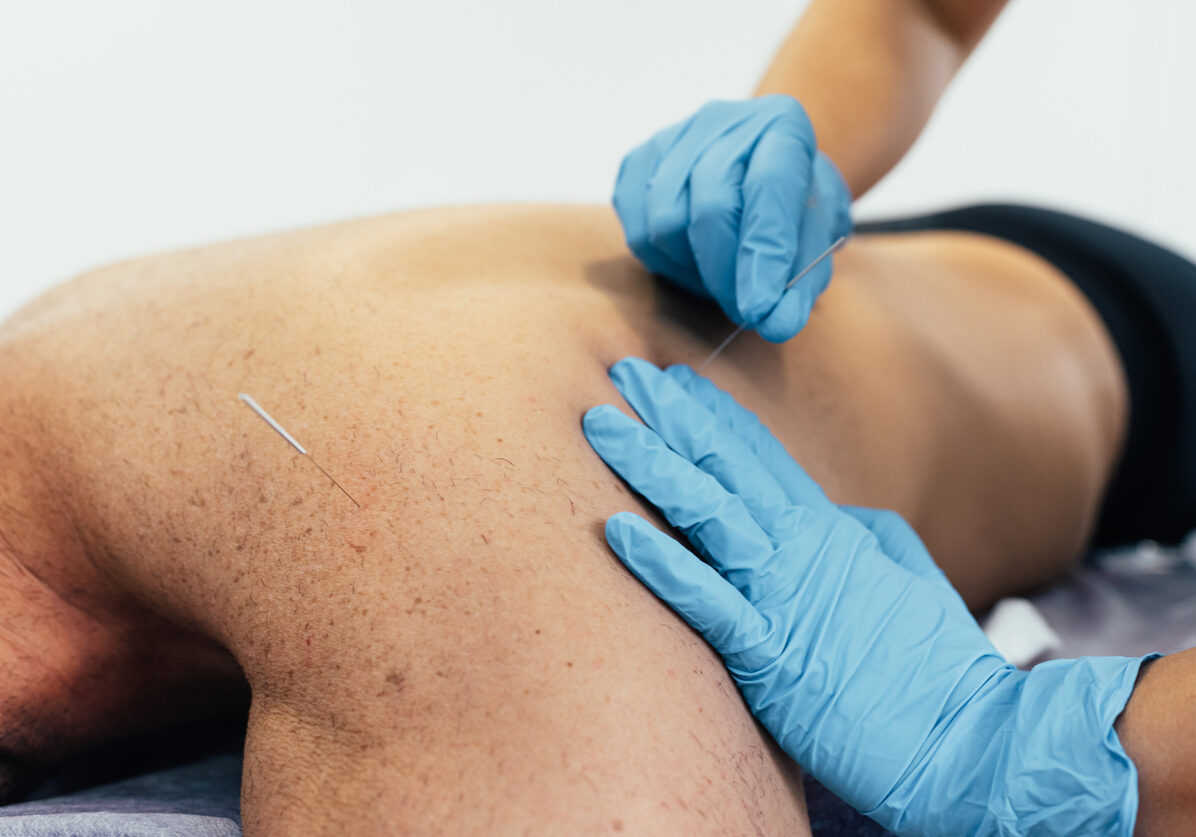 Physiotherapist performing a dry needling treatment on a sick patient with back pain. Health concept